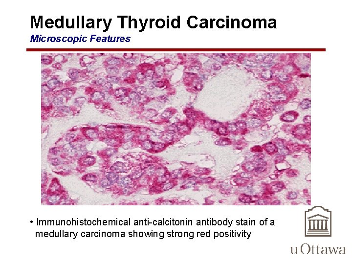 Medullary Thyroid Carcinoma Microscopic Features • Immunohistochemical anti-calcitonin antibody stain of a medullary carcinoma