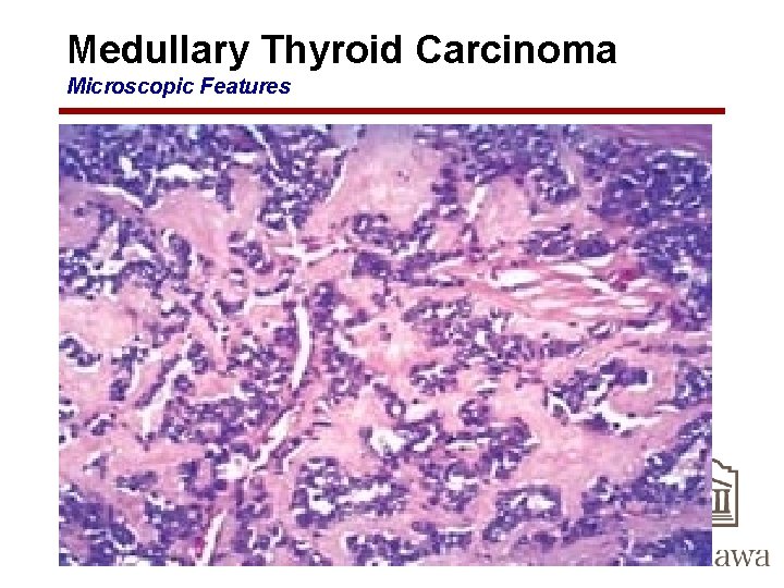 Medullary Thyroid Carcinoma Microscopic Features 