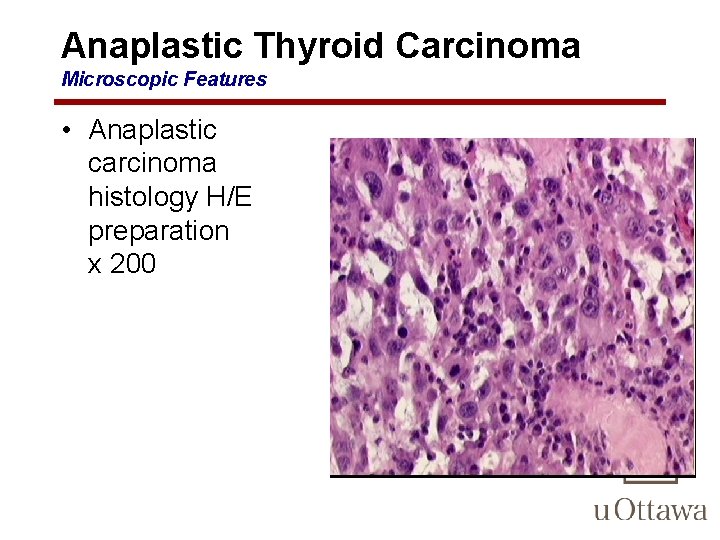 Anaplastic Thyroid Carcinoma Microscopic Features • Anaplastic carcinoma histology H/E preparation x 200 