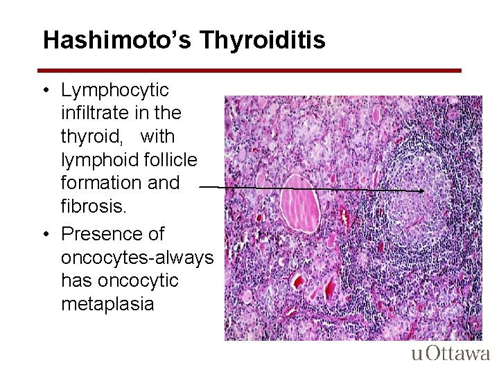 Hashimoto’s Thyroiditis • Lymphocytic infiltrate in the thyroid, with lymphoid follicle formation and fibrosis.