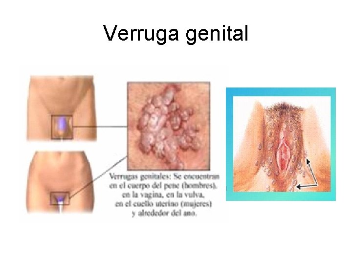 Verruga genital 