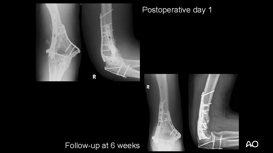 Postoperative day 1 Follow-up at 6 weeks 