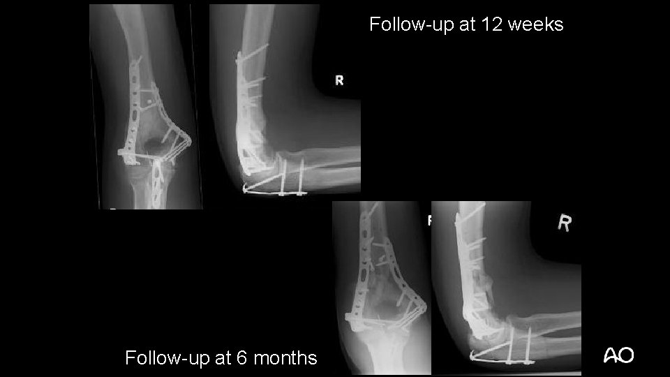 Follow-up at 12 weeks Follow-up at 6 months 