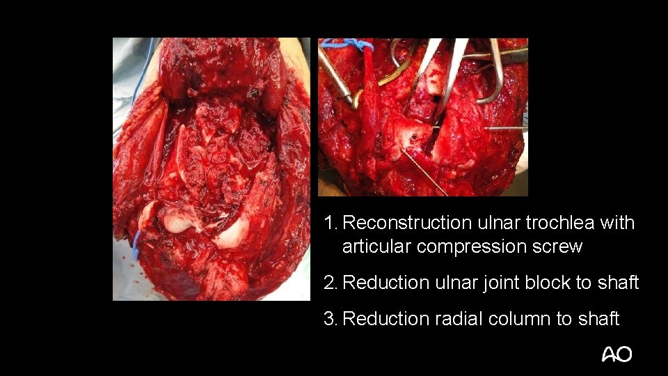 1. Reconstruction ulnar trochlea with articular compression screw 2. Reduction ulnar joint block to
