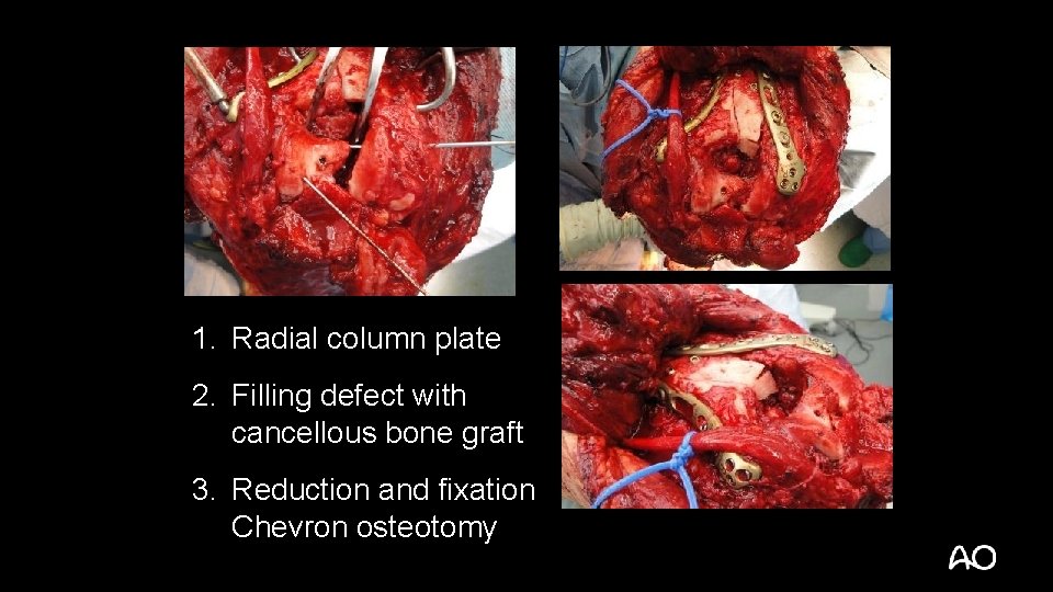 1. Radial column plate 2. Filling defect with cancellous bone graft 3. Reduction and