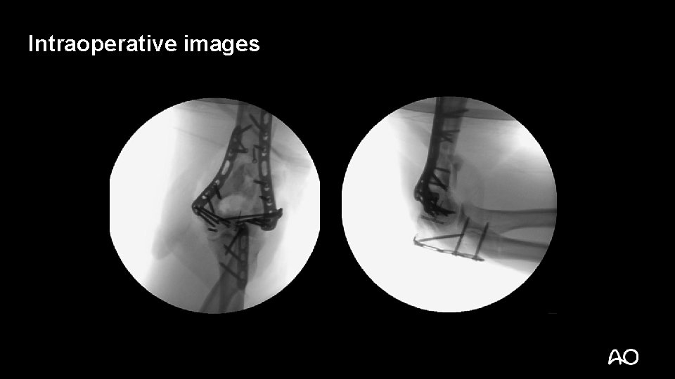 Intraoperative images 