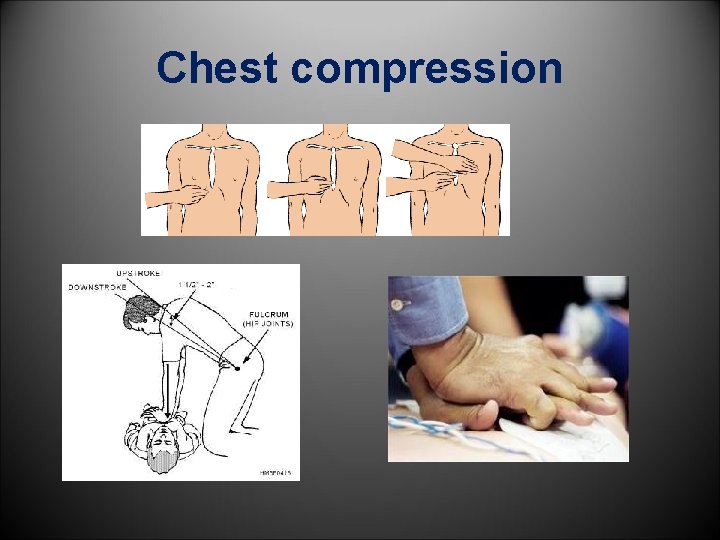 Chest compression 