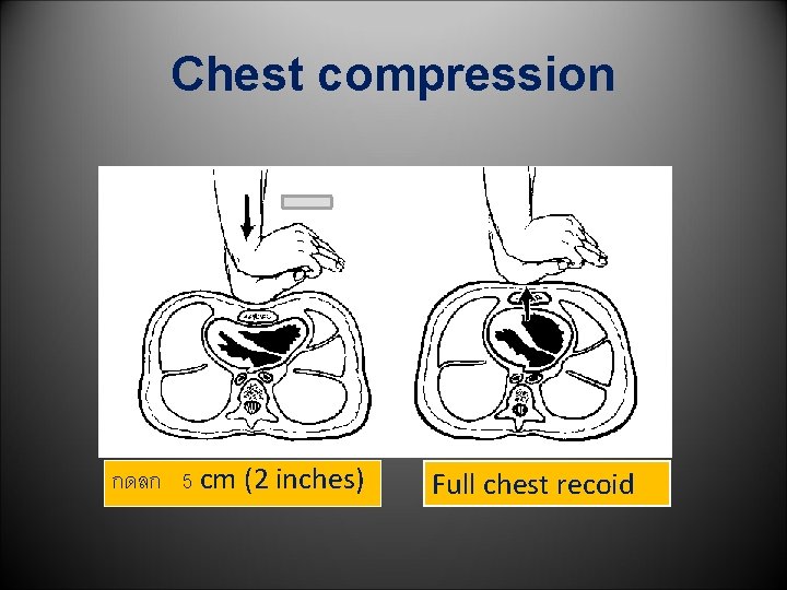 Chest compression กดลก 5 cm (2 inches) Full chest recoid 