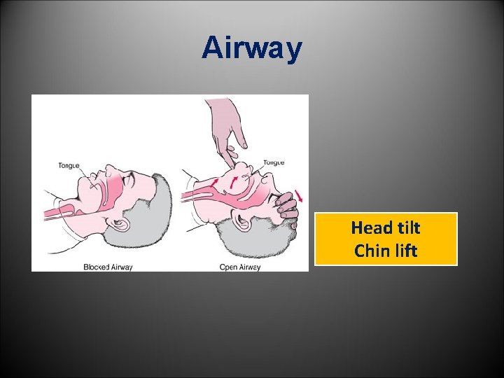 Airway Head tilt Chin lift 