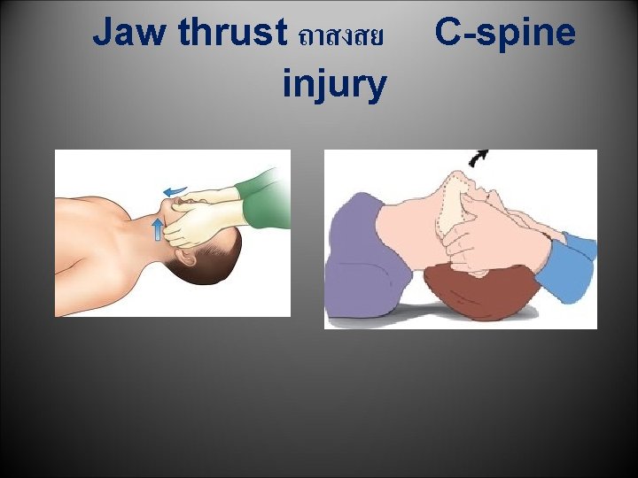 Jaw thrust ถาสงสย injury C-spine 