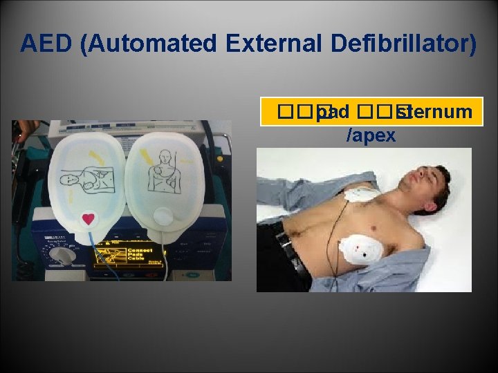 AED (Automated External Defibrillator) ��� pad ��� sternum /apex 