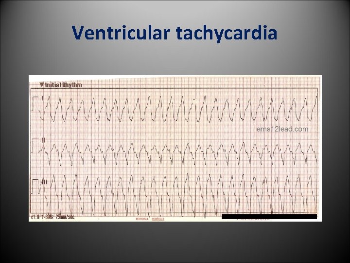 Ventricular tachycardia 