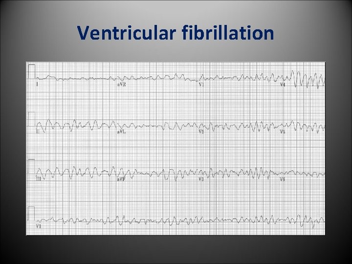 Ventricular fibrillation 