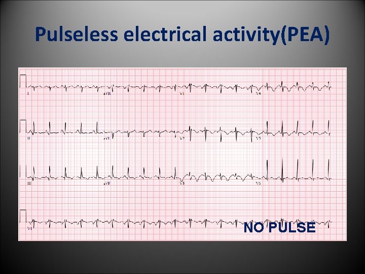 Pulseless electrical activity(PEA) NO PULSE 