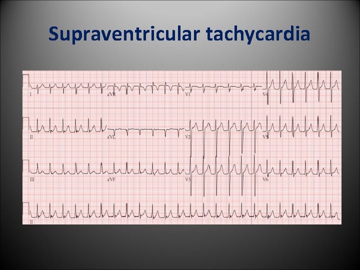 Supraventricular tachycardia 