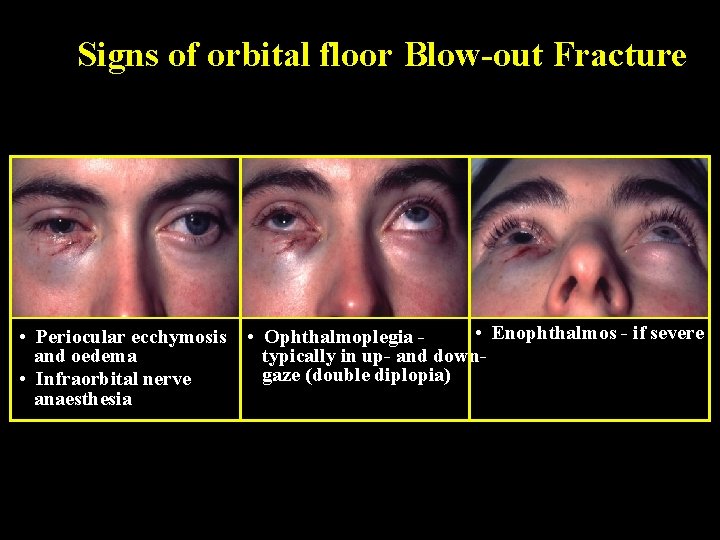 Signs of orbital floor Blow-out Fracture • Periocular ecchymosis and oedema • Infraorbital nerve