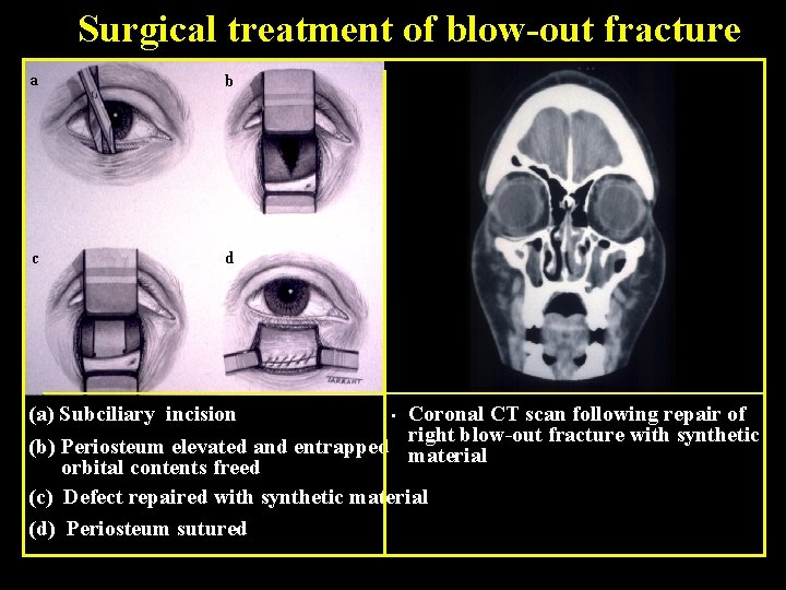 Surgical treatment of blow-out fracture a b c d (a) Subciliary incision • Coronal