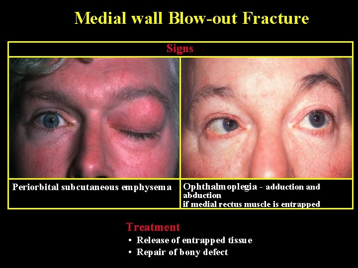 Medial wall Blow-out Fracture Signs Periorbital subcutaneous emphysema Ophthalmoplegia - adduction and abduction if