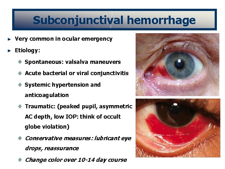 Subconjunctival hemorrhage Very common in ocular emergency Etiology: Spontaneous: valsalva maneuvers Acute bacterial or