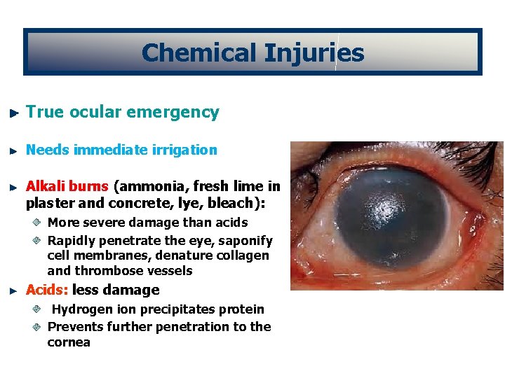 Chemical Injuries True ocular emergency Needs immediate irrigation Alkali burns (ammonia, fresh lime in