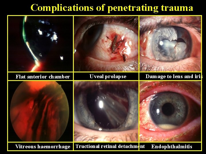 Complications of penetrating trauma Flat anterior chamber Uveal prolapse Vitreous haemorrhage Tractional retinal detachment