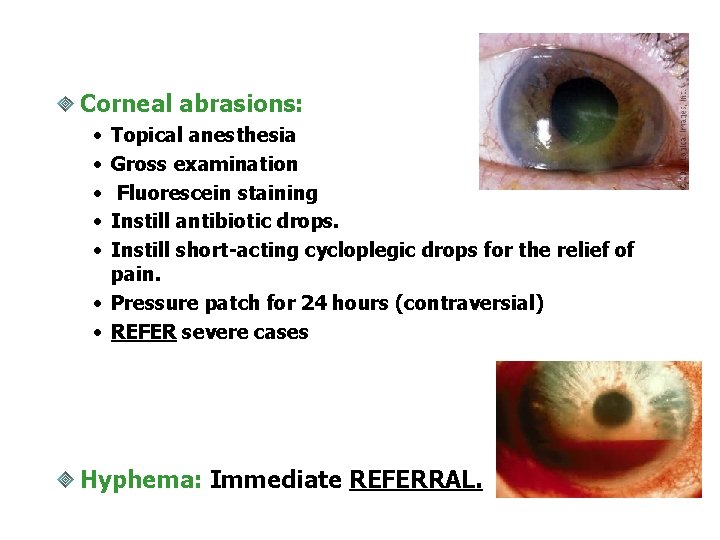 Corneal abrasions: • • • Topical anesthesia Gross examination Fluorescein staining Instill antibiotic drops.