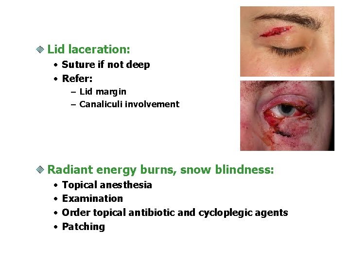 Lid laceration: • Suture if not deep • Refer: – Lid margin – Canaliculi