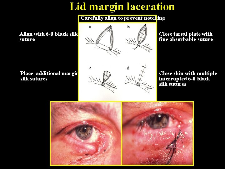 Lid margin laceration Carefully align to prevent notching Align with 6 -0 black silk