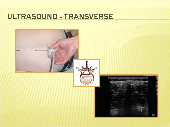 ULTRASOUND - TRANSVERSE 