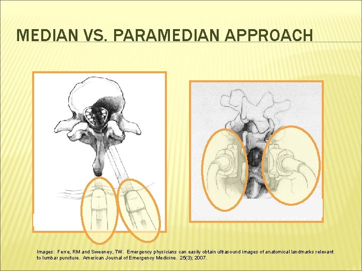 MEDIAN VS. PARAMEDIAN APPROACH Images: Ferre, RM and Sweeney, TW. Emergency physicians can easily