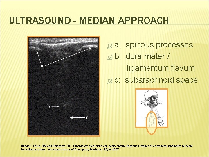 ULTRASOUND - MEDIAN APPROACH a: spinous processes b: dura mater / ligamentum flavum c:
