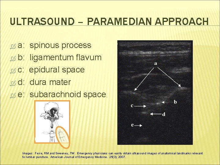 ULTRASOUND – PARAMEDIAN APPROACH a: b: c: d: e: spinous process ligamentum flavum epidural