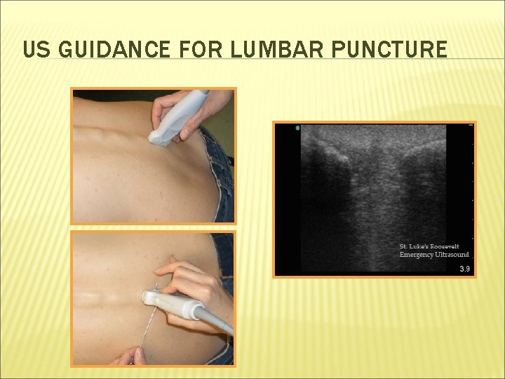 US GUIDANCE FOR LUMBAR PUNCTURE 