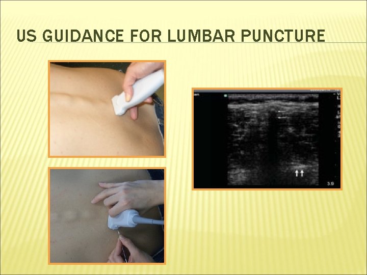 US GUIDANCE FOR LUMBAR PUNCTURE 