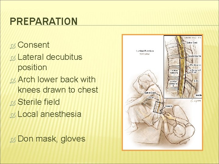 PREPARATION Consent Lateral decubitus position Arch lower back with knees drawn to chest Sterile
