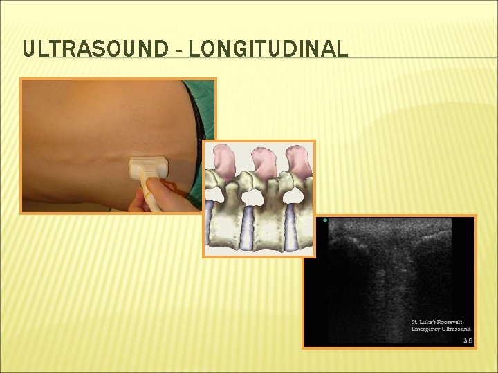 ULTRASOUND - LONGITUDINAL 