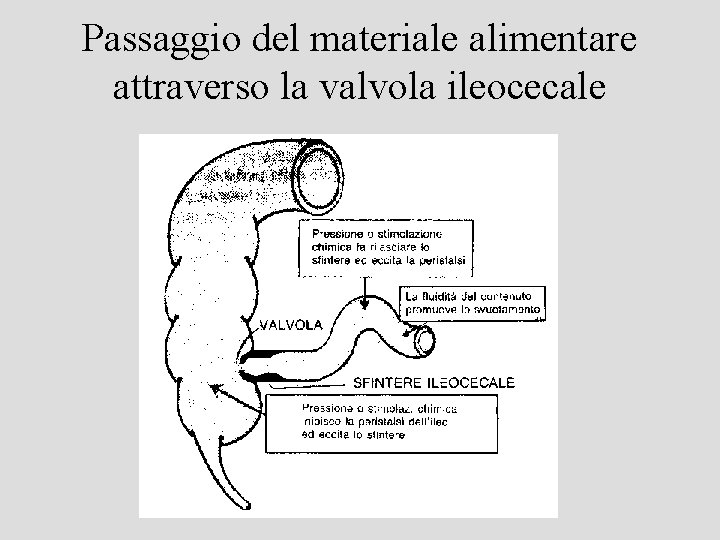 Passaggio del materiale alimentare attraverso la valvola ileocecale 
