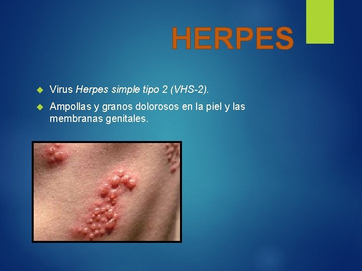 HERPES Virus Herpes simple tipo 2 (VHS-2). Ampollas y granos dolorosos en la piel