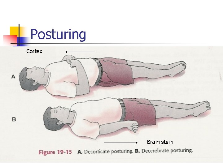 Posturing Cortex Brain stem 