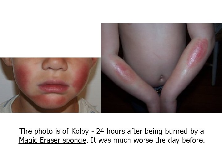 The photo is of Kolby - 24 hours after being burned by a Magic