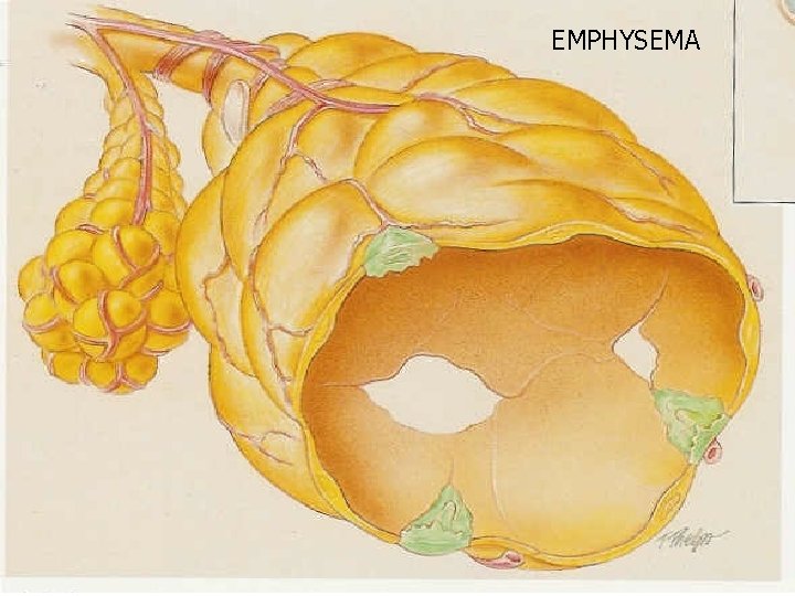 EMPHYSEMA 