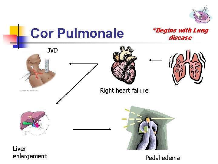 Cor Pulmonale *Begins with Lung disease JVD Right heart failure Liver enlargement Pedal edema