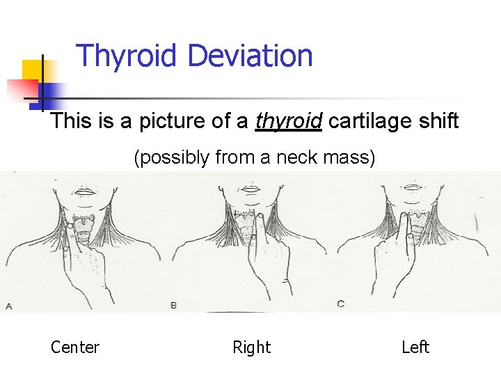Thyroid Deviation This is a picture of a thyroid cartilage shift (possibly from a