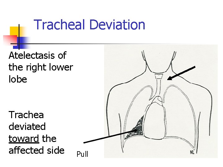 Tracheal Deviation Atelectasis of the right lower lobe Trachea deviated toward the affected side