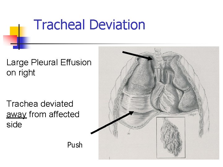 Tracheal Deviation Large Pleural Effusion on right Trachea deviated away from affected side Push