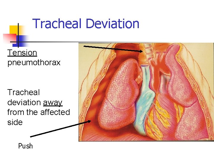 Tracheal Deviation Tension pneumothorax Tracheal deviation away from the affected side Push 