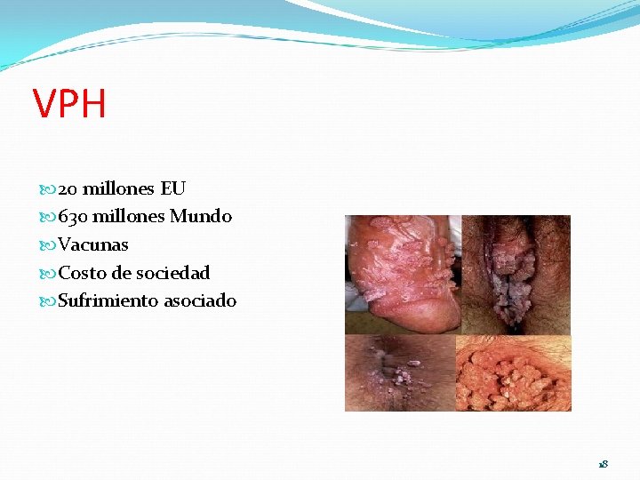 VPH 20 millones EU 630 millones Mundo Vacunas Costo de sociedad Sufrimiento asociado 18 VPH 20 millones EU 630 millones Mundo Vacunas Costo de sociedad Sufrimiento asociado 18
