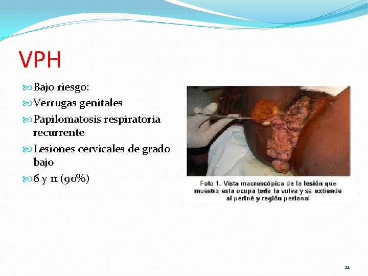 VPH Bajo riesgo: Verrugas genitales Papilomatosis respiratoria recurrente Lesiones cervicales de grado bajo 6 VPH Bajo riesgo: Verrugas genitales Papilomatosis respiratoria recurrente Lesiones cervicales de grado bajo 6