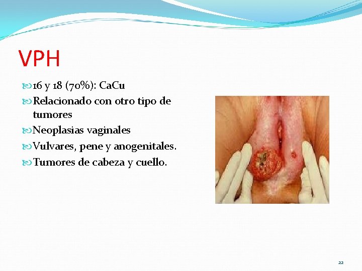 VPH 16 y 18 (70%): Ca. Cu Relacionado con otro tipo de tumores Neoplasias VPH 16 y 18 (70%): Ca. Cu Relacionado con otro tipo de tumores Neoplasias