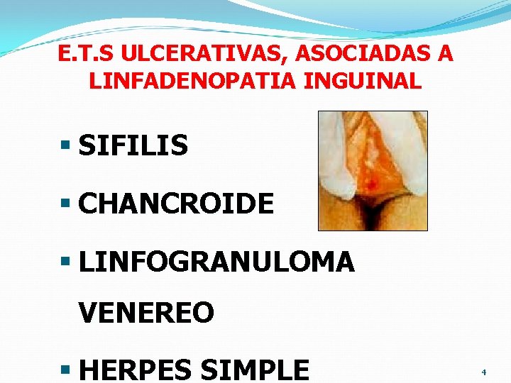 E. T. S ULCERATIVAS, ASOCIADAS A LINFADENOPATIA INGUINAL § SIFILIS § CHANCROIDE § LINFOGRANULOMA E. T. S ULCERATIVAS, ASOCIADAS A LINFADENOPATIA INGUINAL § SIFILIS § CHANCROIDE § LINFOGRANULOMA